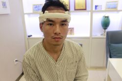 -大麦微针植发丨全国连锁