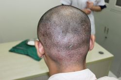 点击看大图 -大麦微针植发丨全国连锁