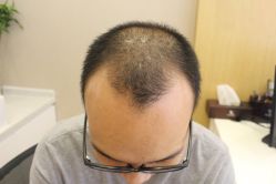 -大麦微针植发丨全国连锁