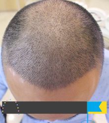 -大麦微针植发丨全国连锁