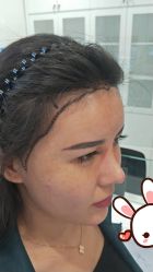 -大麦微针植发丨全国连锁