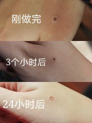 -痣缘宫