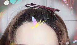 -大麦微针植发全国连锁