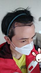 -大麦微针植发丨全国连锁