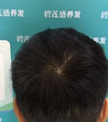 -碧莲盛·不剃发植发