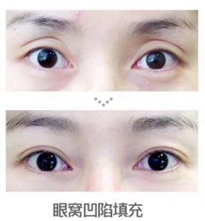 -西施无菌半永久纹绣眉眼影唇轻增发纹发际线
