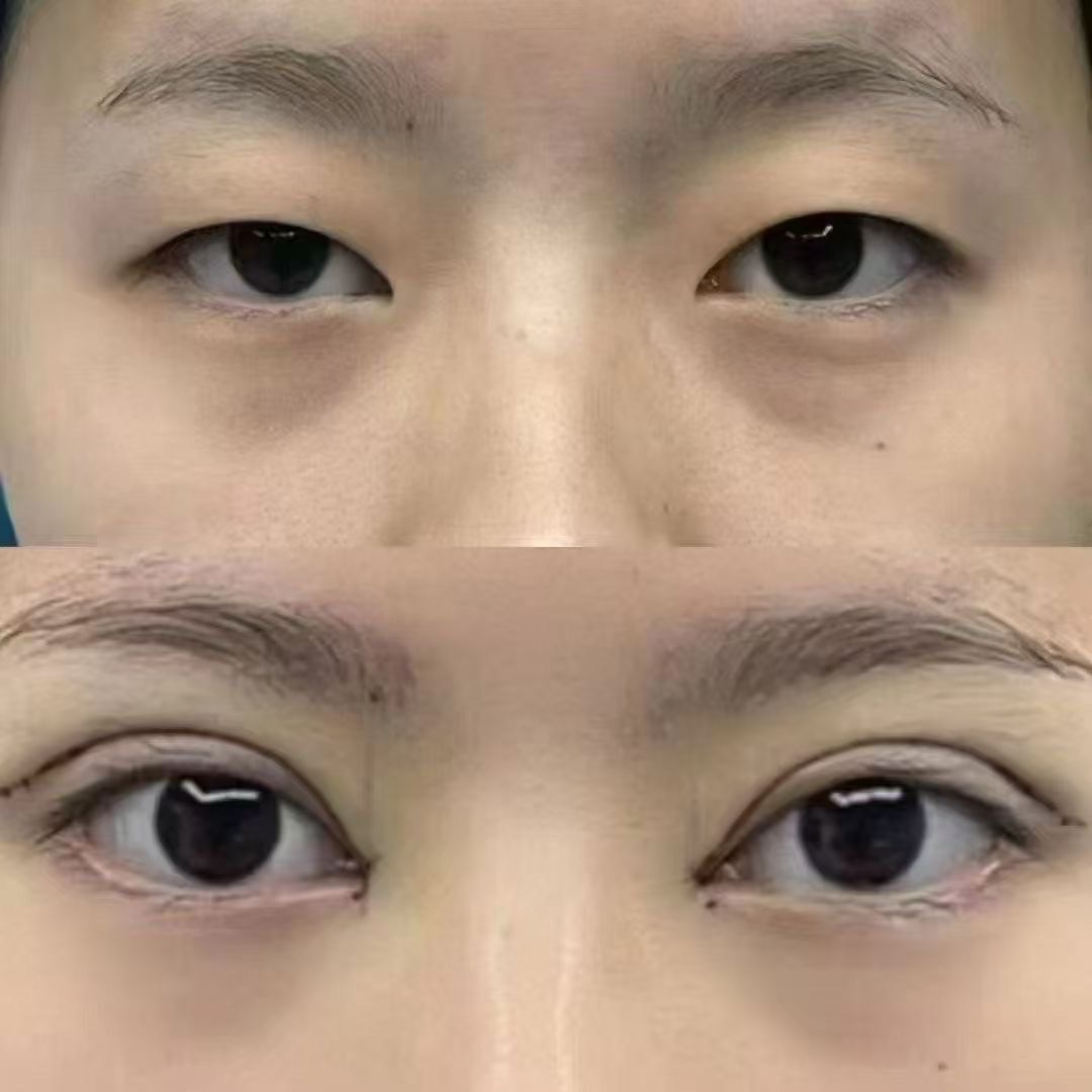割双眼皮前后对比