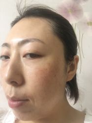 这是刚做完治疗拍的照片-北京京通医院医疗美容