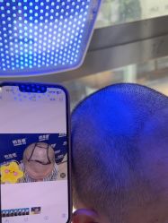 -碧莲盛·不剃发植发