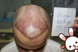 -大麦微针植发丨全国连锁