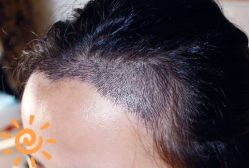 -大麦微针植发丨全国连锁