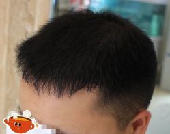 -大麦微针植发丨全国连锁