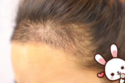 -大麦微针植发丨全国连锁