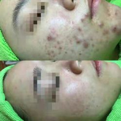 -苗医生草本科技祛痘