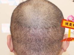 -大麦微针植发全国连锁