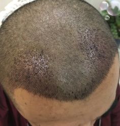 -大麦微针植发丨全国连锁