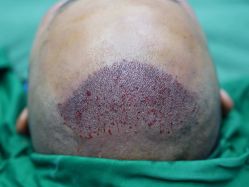 点击看大图 体验前-大麦微针植发丨全国连锁