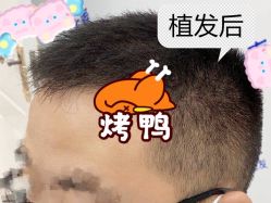 -大麦微针植发全国连锁