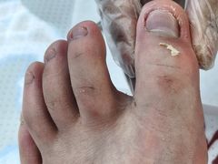 -扬州修脚·甲沟炎·灰指甲(热河路店)