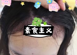 -大麦微针植发全国连锁