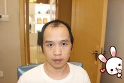 -大麦微针植发丨全国连锁