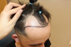 -大麦微针植发丨全国连锁