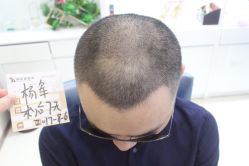 点击看大图 -大麦微针植发丨全国连锁