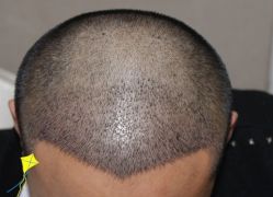 -大麦微针植发丨全国连锁