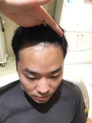 -大麦微针植发全国连锁