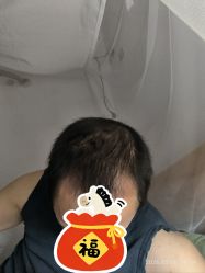 -大麦微针植发全国连锁