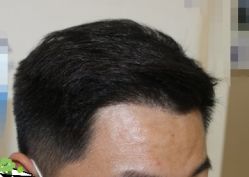 -大麦微针植发丨全国连锁