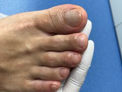 -Andrew指甲专科灰指甲·甲沟炎矫正·3D步态矫形鞋垫定制(上海法华镇路旗舰店)
