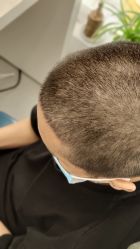 -大麦微针植发全国连锁