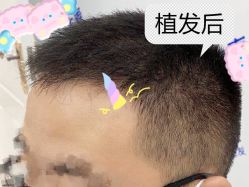 -大麦微针植发全国连锁