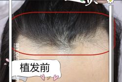 -大麦微针植发全国连锁