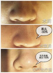 脸部抗衰-光SPA科技美肤