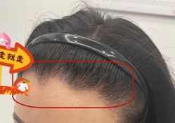 -大麦微针植发全国连锁