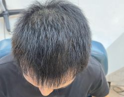 -大麦微针植发全国连锁