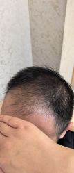 -大麦微针植发丨全国连锁