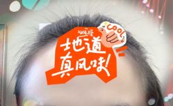 -大麦微针植发全国连锁