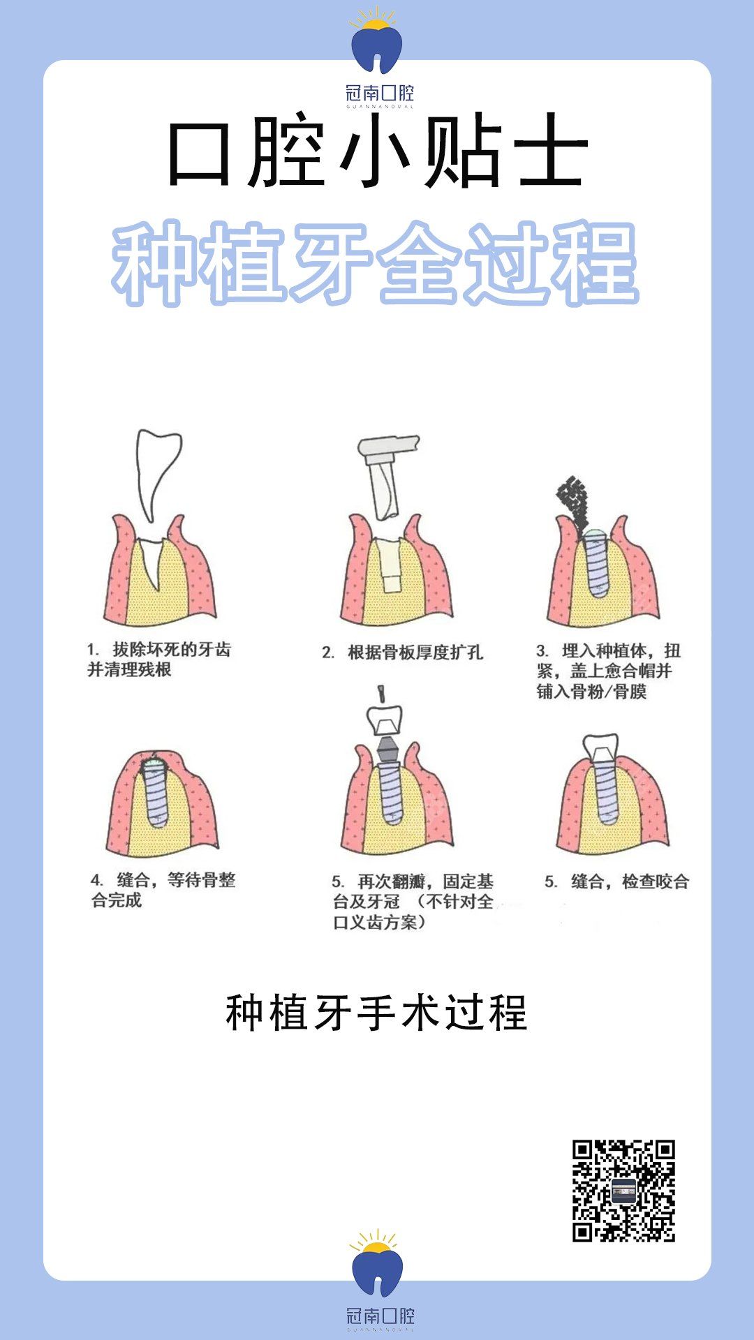 种植牙全过程