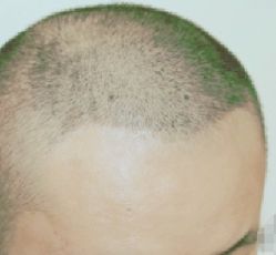 -大麦微针植发丨全国连锁