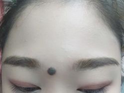 体验前-北京美痣堂古方祛痣斑疣瘊