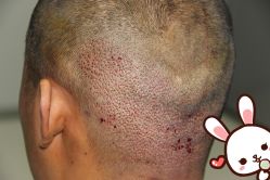 点击看大图 -大麦微针植发丨全国连锁