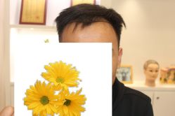 -大麦微针植发丨全国连锁