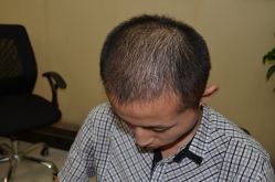 -大麦微针植发丨全国连锁