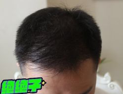 -大麦微针植发丨全国连锁