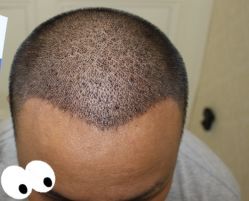 -大麦微针植发丨全国连锁