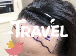 -大麦微针植发全国连锁