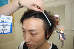 -大麦微针植发丨全国连锁